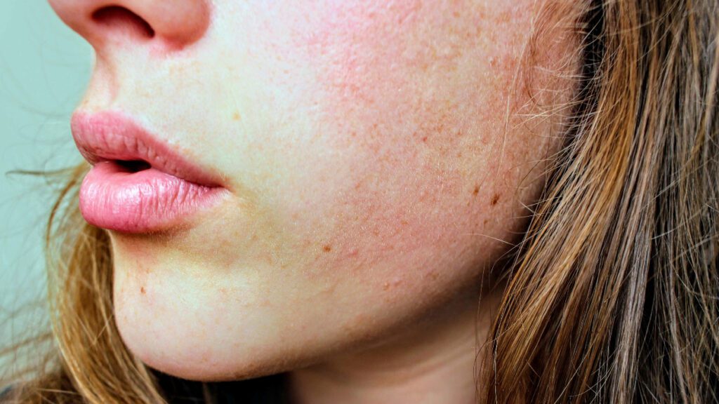 Dermatologists' expert tips for relieving dry skin